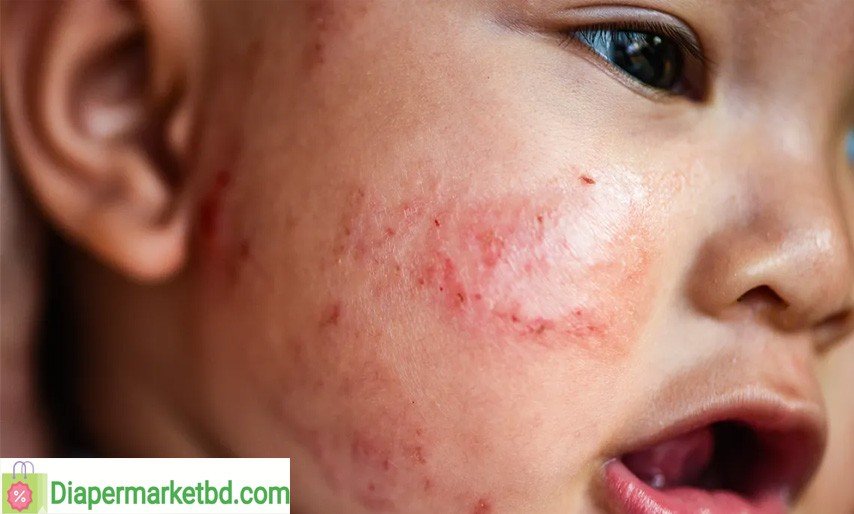 Baby Eczema: Causes & Treatment